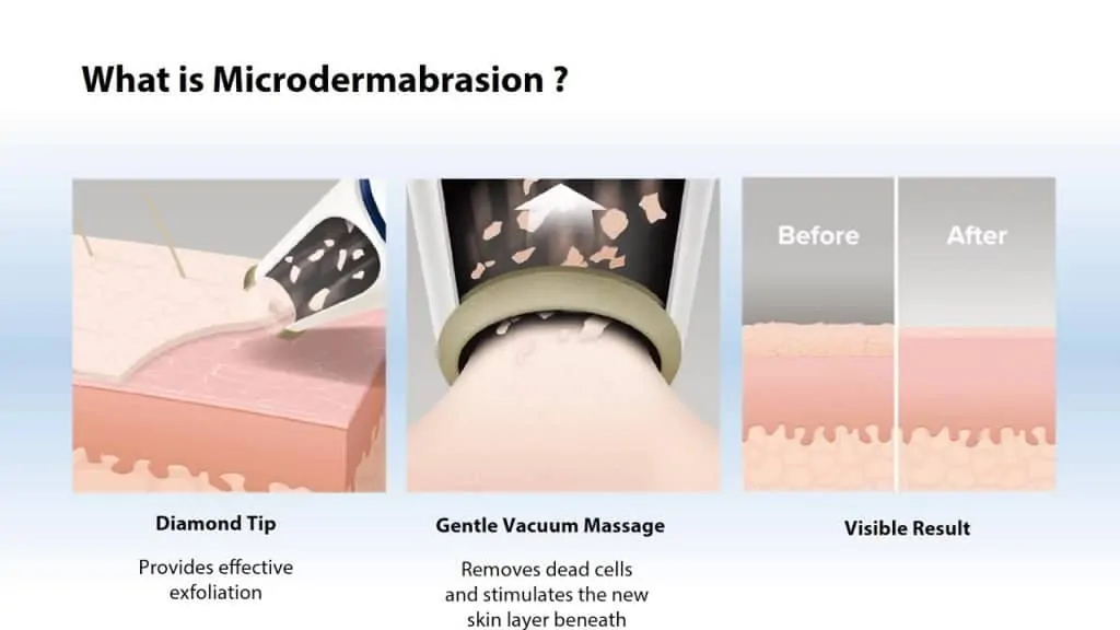 What is Microdermabrasion