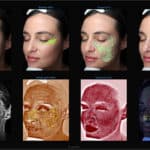 VISIA - Facial Analysis 