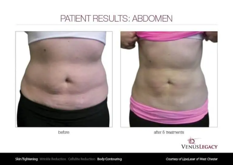 Venus Legacy abdomen - skin tightening
