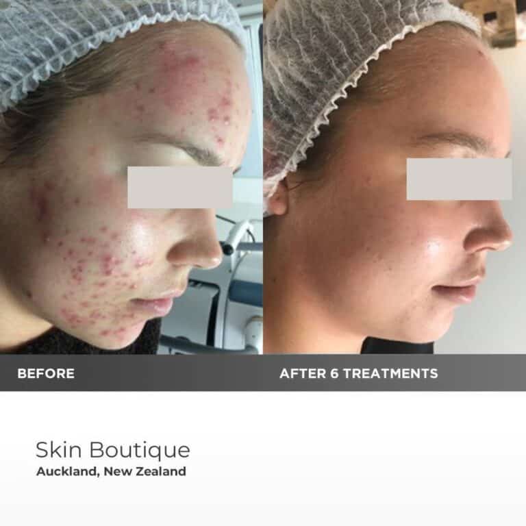 Before/ After Dermapen: acnee inflamatorie