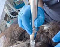 Mezoterapie Microneedle pentru par si scalp Meso hair